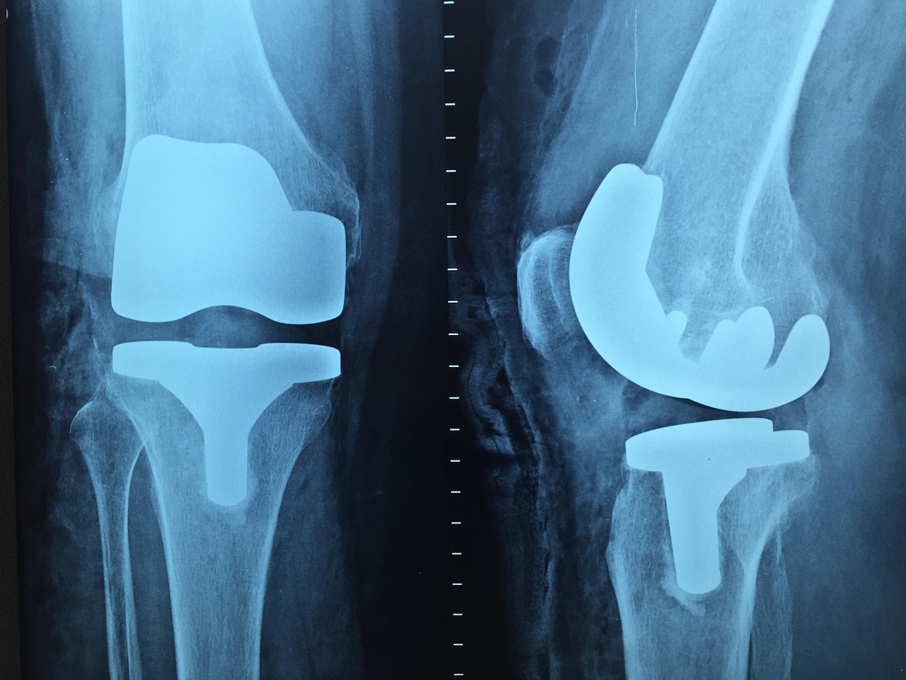 What to Expect From Robotic Knee Replacement Surgery in 2025?