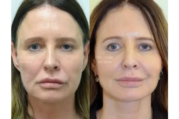 neck lift london