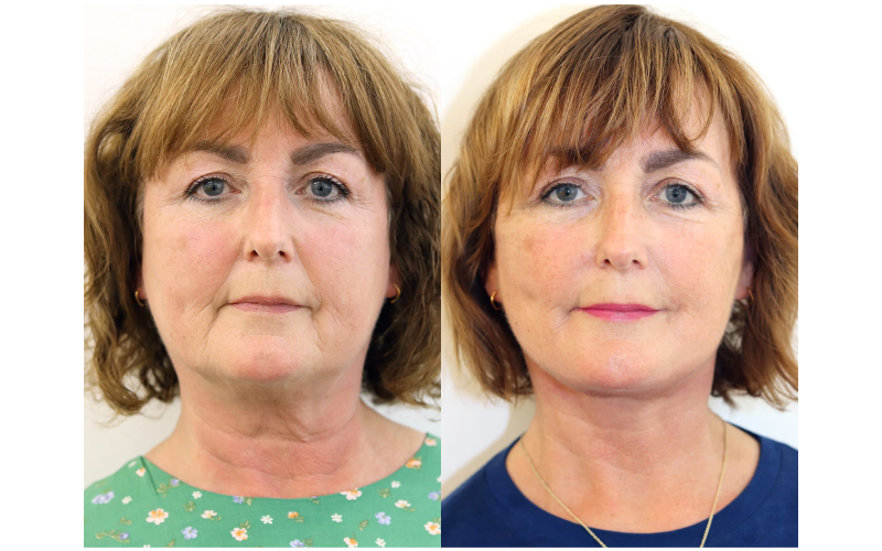 neck lift london