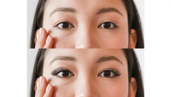 eyelid surgery London