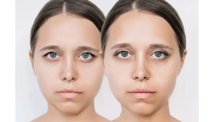 eyelid surgery London